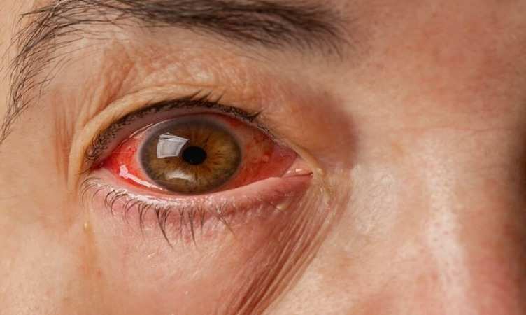 Delhi-NCR और Noida में तेजी से फैला Eye Flu, आखिर क्या है बीमारी की वजह