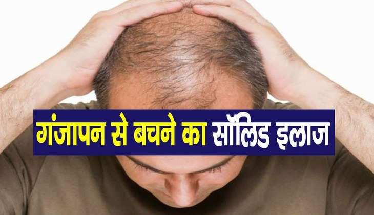 Hair Care Tips: कम उम्र में सिर हो गया है टकला? ये तेल कर सकता है चमत्कार, जानें कैसे करें इस्तेमाल