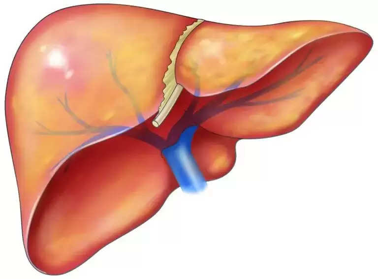 Fatty liver disease: बहुत खतरनाक होता है फैटी लीवर, इन लक्षणों पर दें ध्यान वरना बीमारी रोकना हो जाएगा नामुमकिन