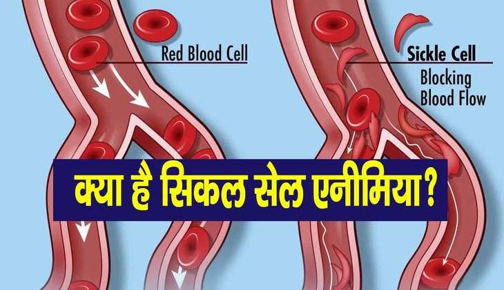 <strong>Sickle Cell Anemia: किडनी और लिवर को डैमेज कर सकता है सिकल सेल एनीमिया, डॉक्टर ने बताएं कैसे शुरुआत में पहचाने इसके लक्षण</strong>