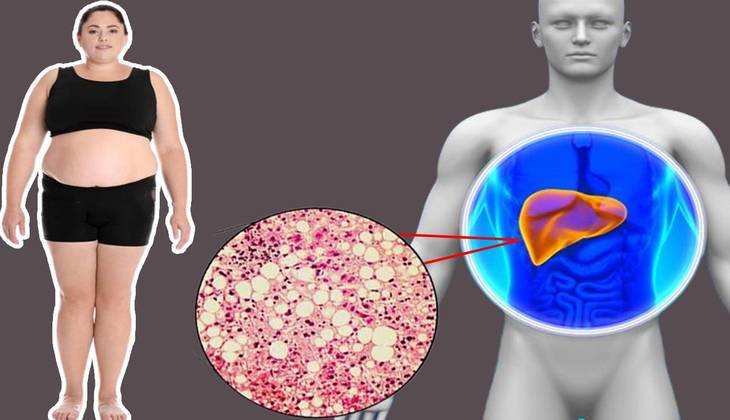 Fatty liver disease: बहुत खतरनाक होता है फैटी लीवर, इन लक्षणों पर दें ध्यान वरना बीमारी रोकना हो जाएगा नामुमकिन