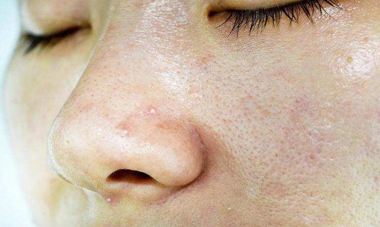 Skin Care Tips: अपनाएं ये घरेलू स्क्रब और मिनटों में चेहरा हो जाएगा व्हाइटहेड्स फ्री