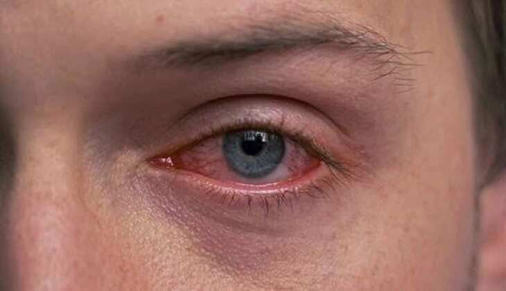 Conjunctivitis Prevention Tips: 5 तरह के Eye Flu से पीड़ित हो रहे लोग, एक्सपर्ट से जानें फैलने से कैसे रोकें?