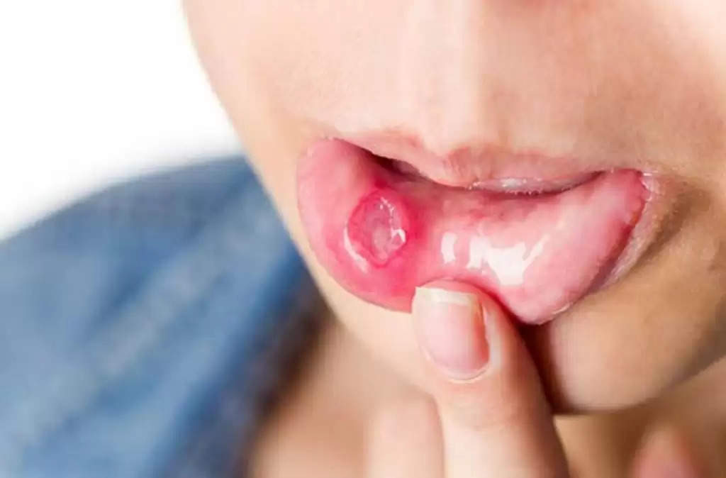 Mouth Ulcer: मुंह के छालों ने कर दिया है परेशान तो ये घरेलू नुस्खें रहेंगे बहुत दमदार