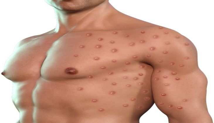 Monkeypox Virus का नाम सुनते ही घबराएं नहीं, जान लें इसके लक्षण, छू भी नहीं पाएगा वायरस