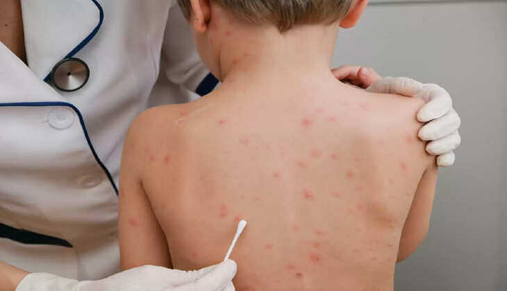  Chickenpox