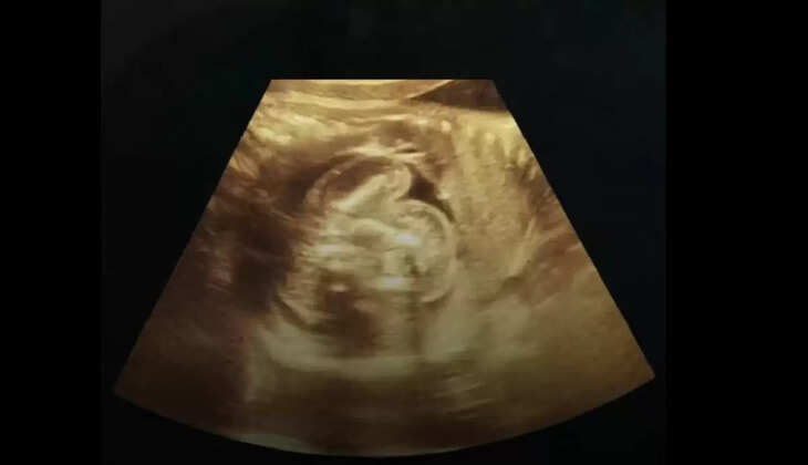 बुलंदशहर: महिला के लीवर में पल रहा था 12 हफ्ते का भ्रूण, डॉक्टर भी रह गए हैरान