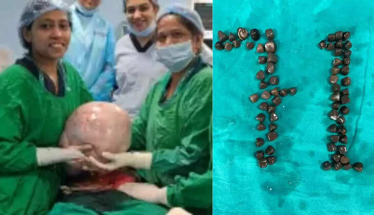 कानपुर और प्रयागराज के डॉक्टरों का कमाल: 72 वर्षीय महिला के पेट से 10 किलो की गांठ और बुज़ुर्ग मरीज की किडनी से 71 पथरियां निकालीं